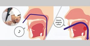 La gastroscopia transnasale